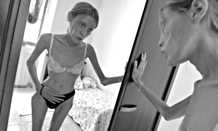 Anorexia Skinny